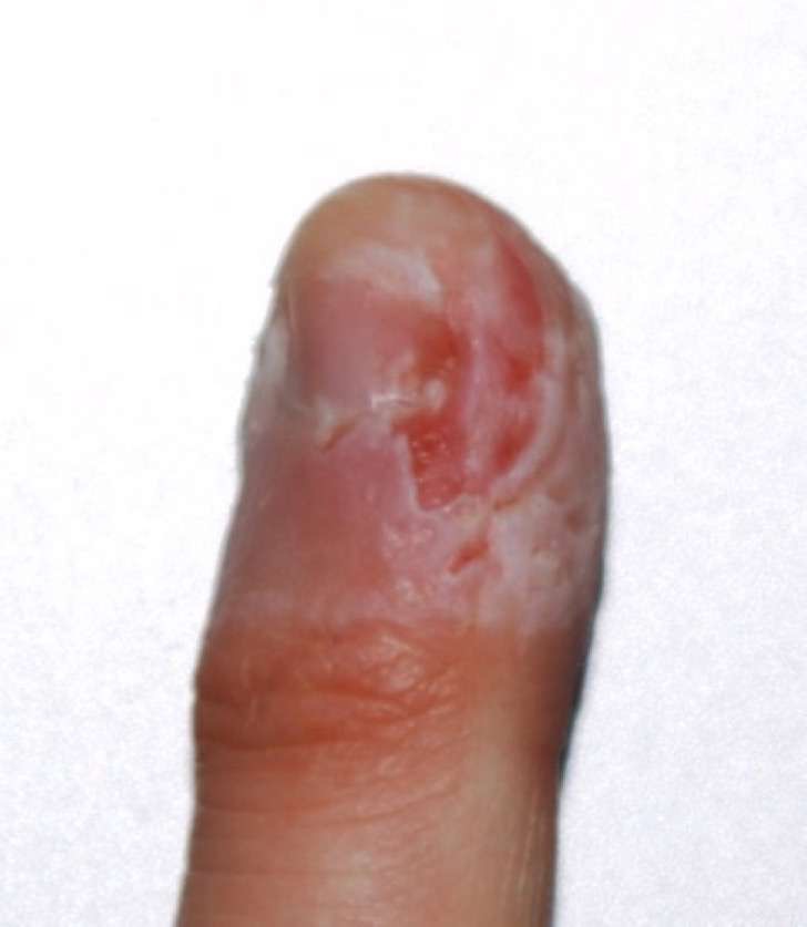 Descubrir 39+ imagen persona que se come las uñas Viaterra.mx