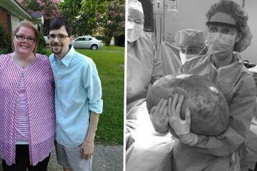 Woman after surgery for 22 kg ovarian cyst, previously misdiagnosed as weight gain