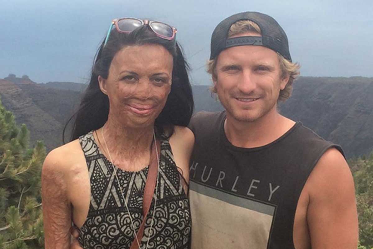 Turia Pitt, la modelo que se quemó el 65% de su cuerpo, se casa ...
